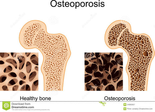 6 self-test methods for bone health